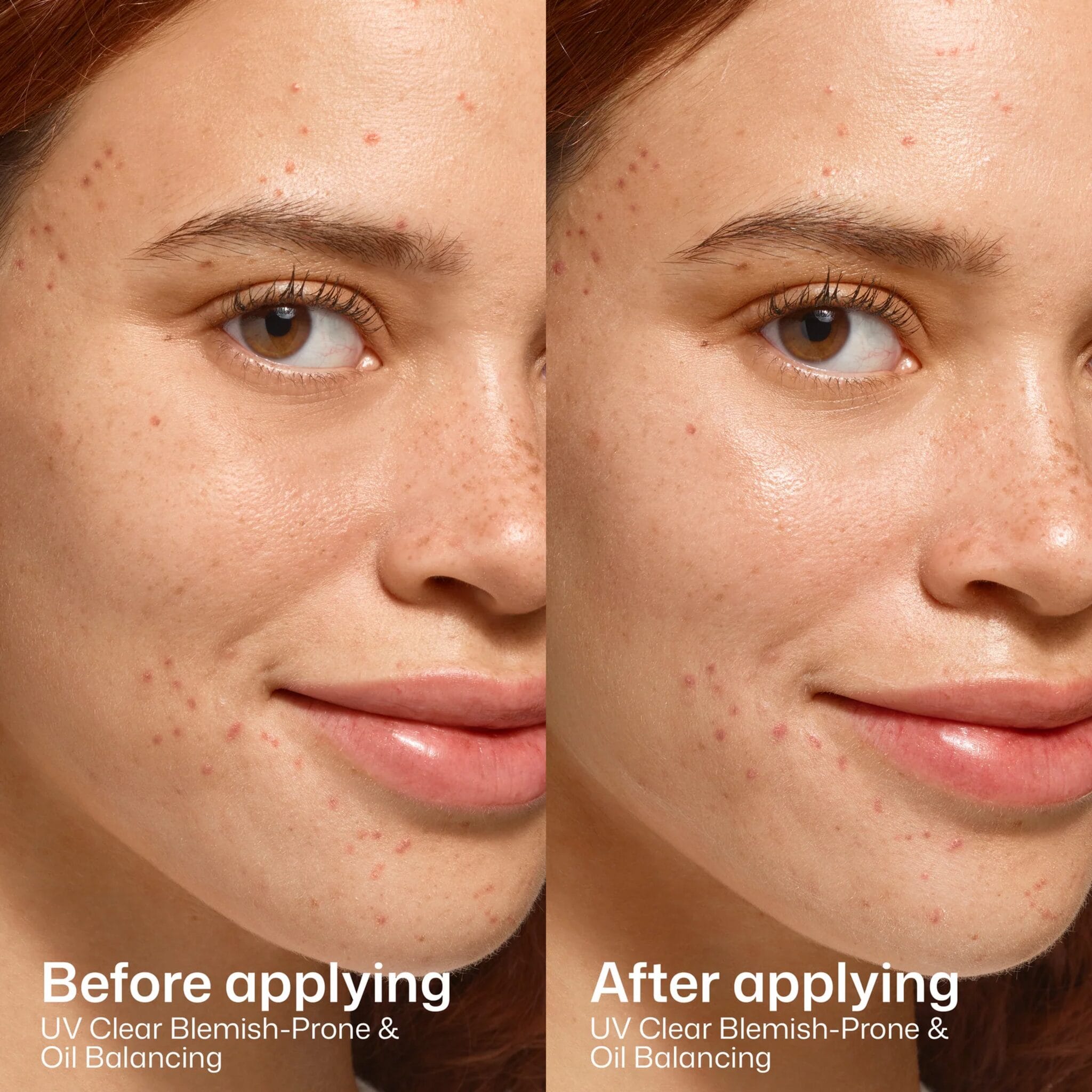 Before and after results using EltaMD UV Clear Blemish-Prone sunscreen
