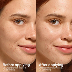 Before and after results using EltaMD UV Clear Blemish-Prone sunscreen
