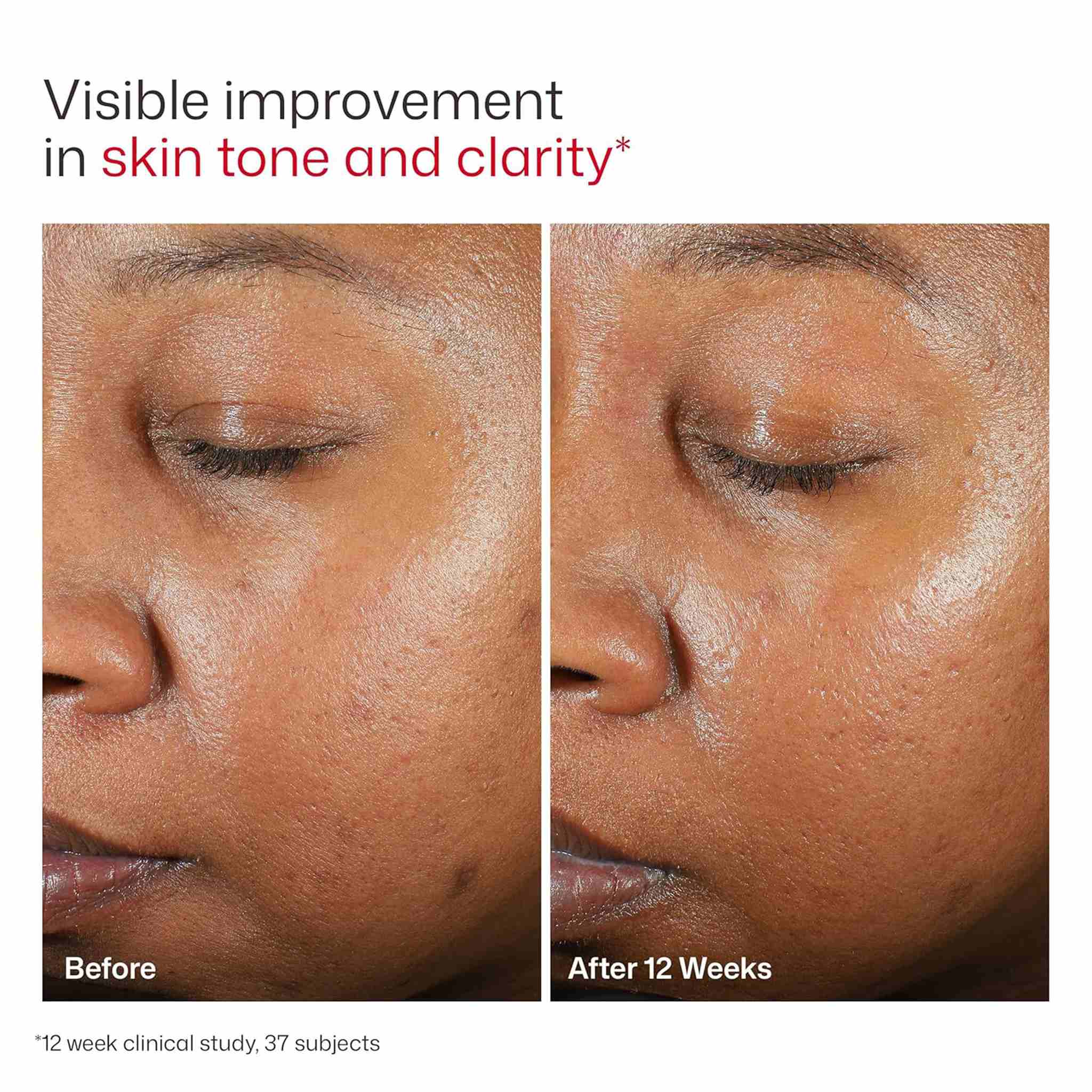 Before and after photos showing improved skin tone and clarity after 12 weeks