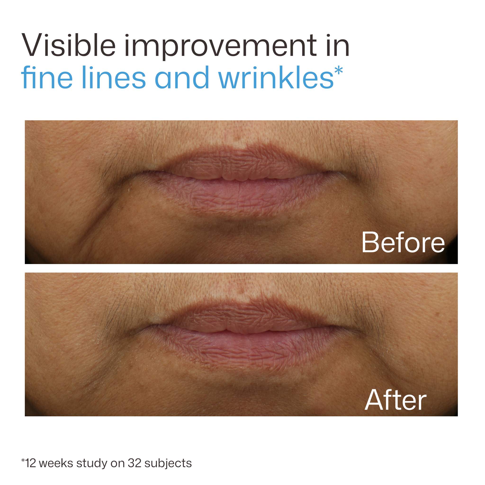 Before and after close-up showing visible improvement in fine lines and wrinkles with EltaMD UV Daily Hydration+
