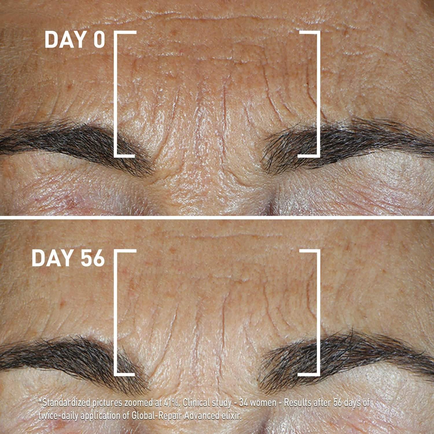Before and after 56 days of Filorga Global-Repair Advanced Elixir showing reduced forehead wrinkles