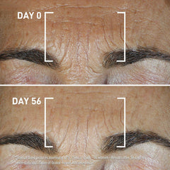 Before and after 56 days of Filorga Global-Repair Advanced Elixir showing reduced forehead wrinkles