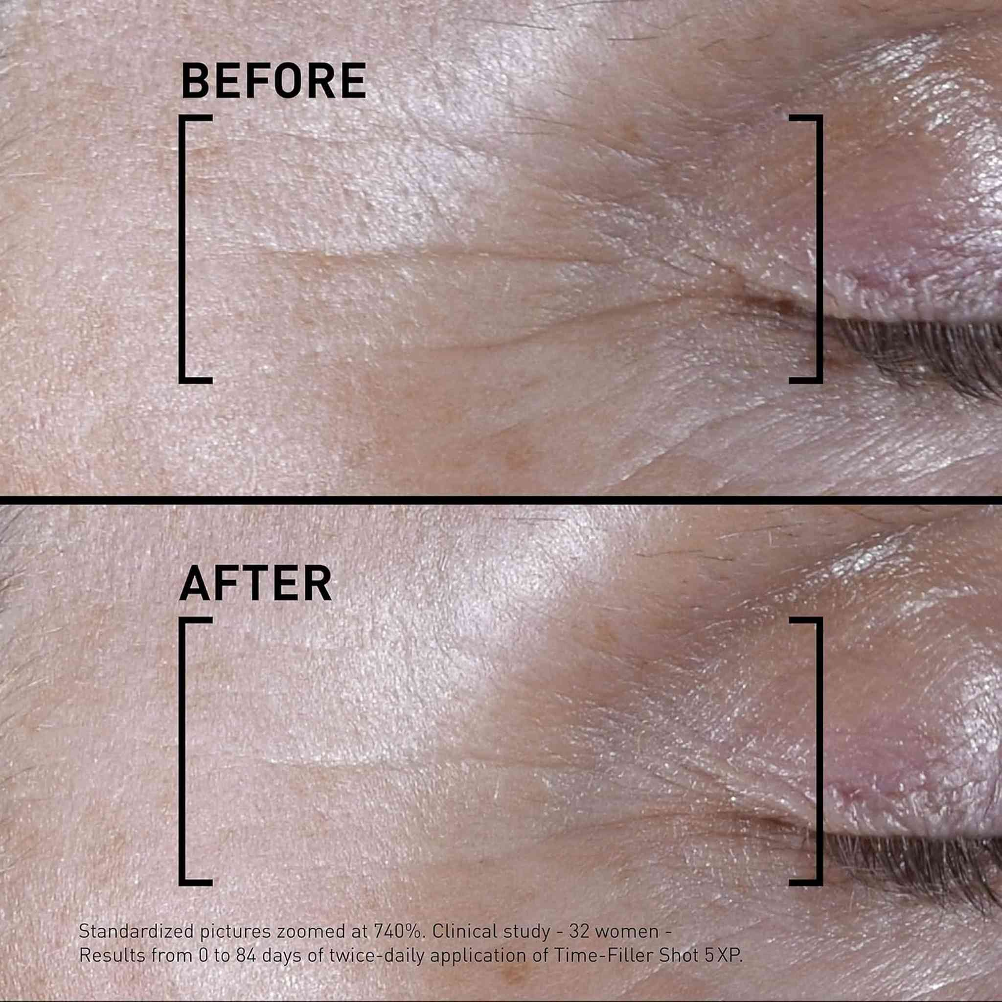 Filorga Time-Filler Shot 5XP before and after skin close-up showing reduced expression lines after 84 days