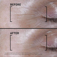 Filorga Time-Filler Shot 5XP before and after skin close-up showing reduced expression lines after 84 days