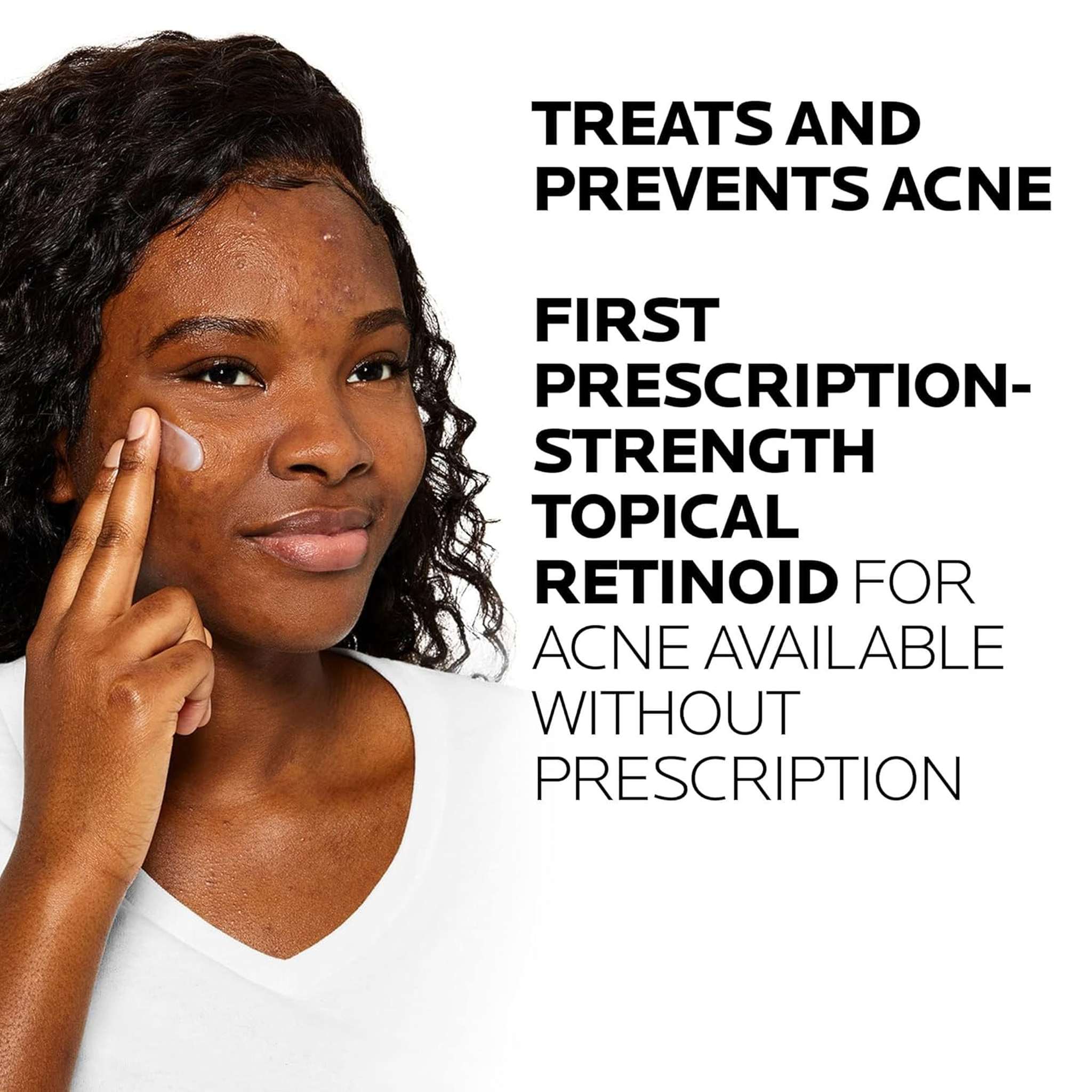 Woman applying Effaclar Adapalene Gel prescription strength acne treatment