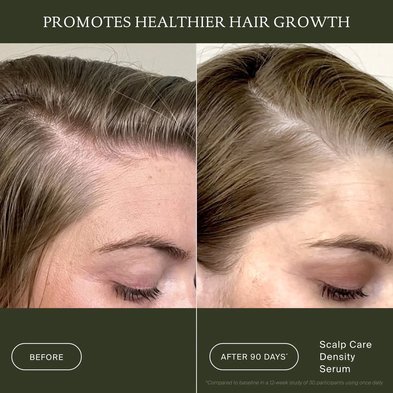 Before and after 90 days of Scalp Care Density Serum showing a fuller-looking hairline and part