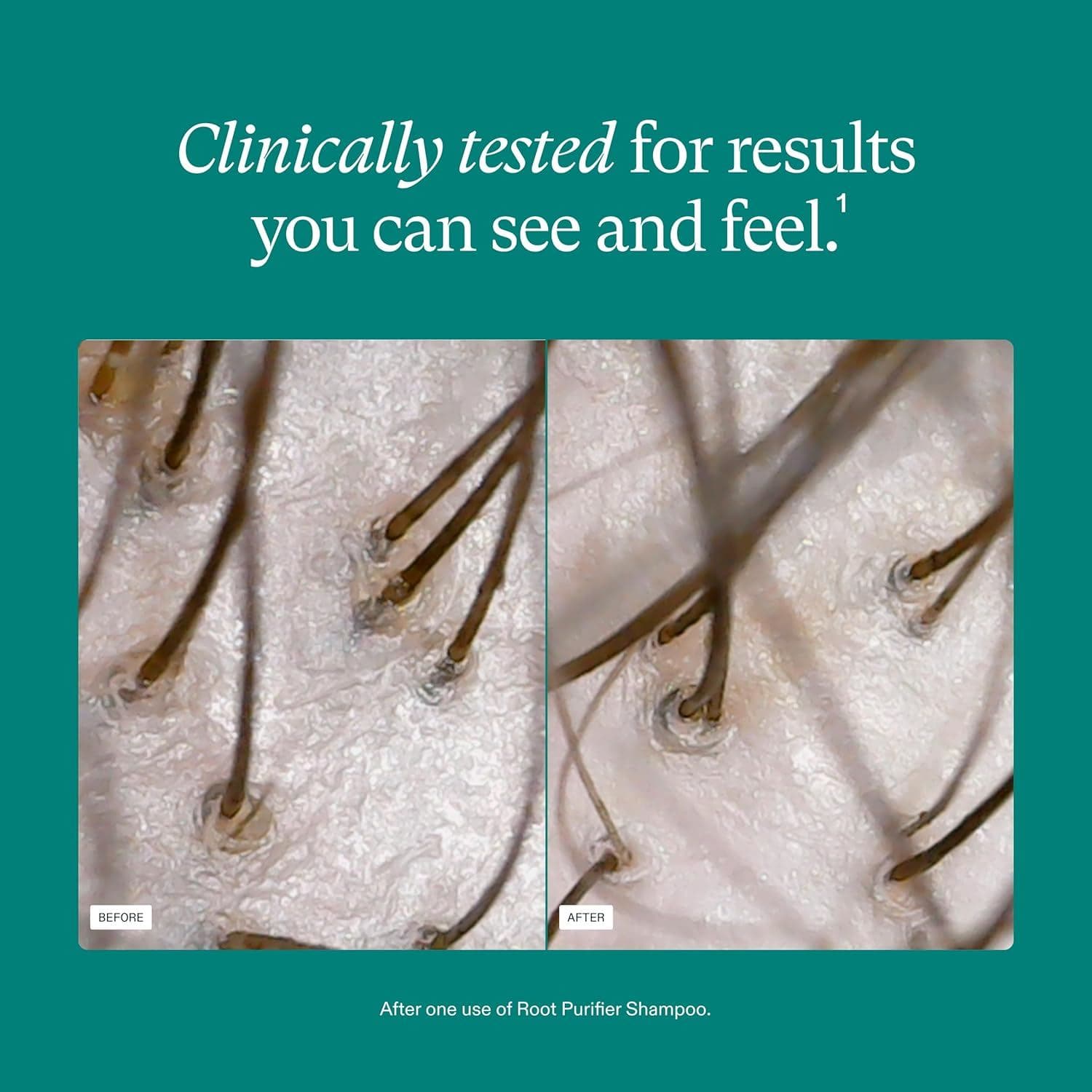 Before and after scalp results using Nutrafol Root Purifier shampoo