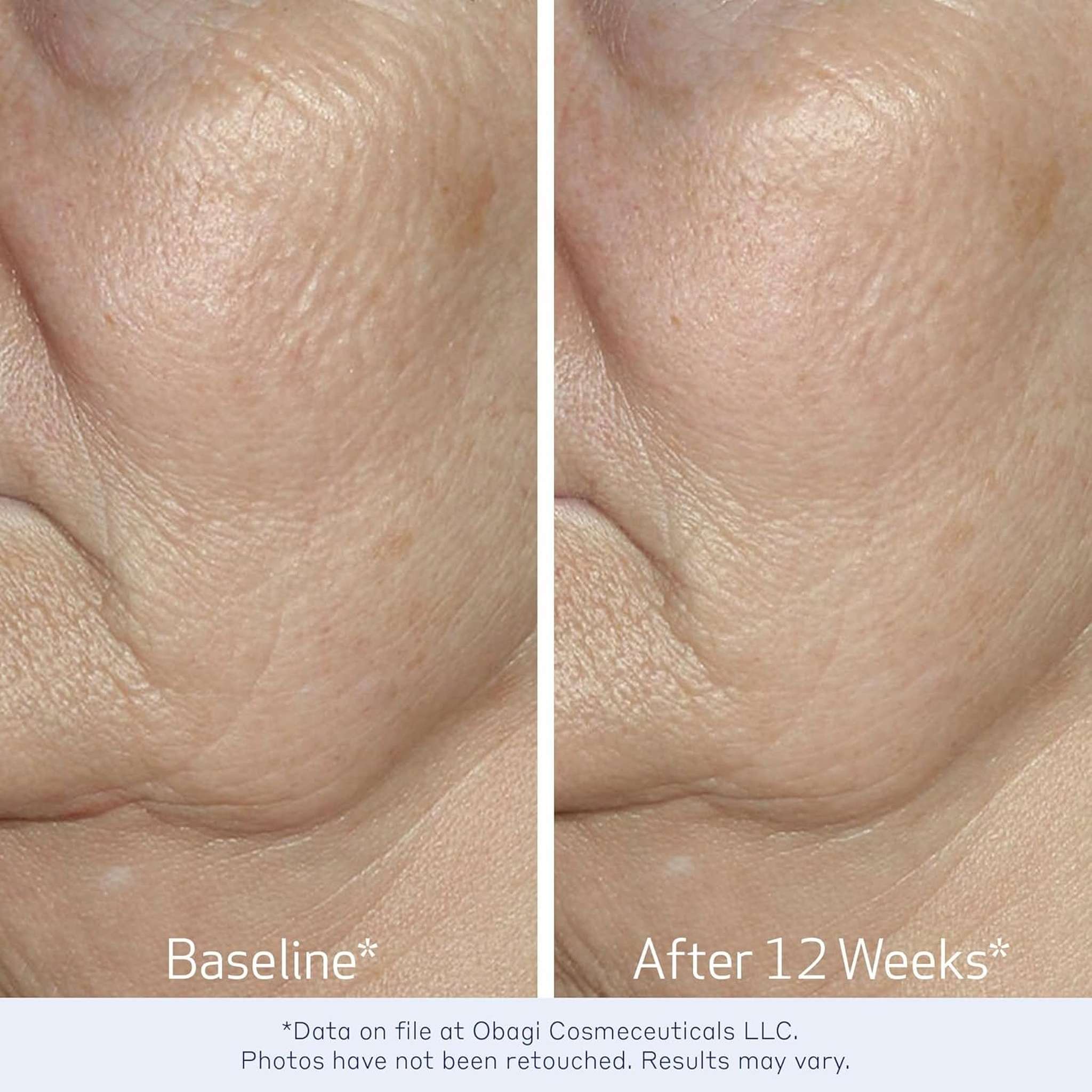 Obagi Medical ElastiDerm before and after 12 weeks smoother eye area crow's feet reduction