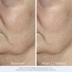 Obagi Medical ElastiDerm before and after 12 weeks smoother eye area crow's feet reduction