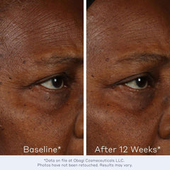 Obagi Medical ElastiDerm before and after 12 weeks reduced eye area wrinkles darker skin tone