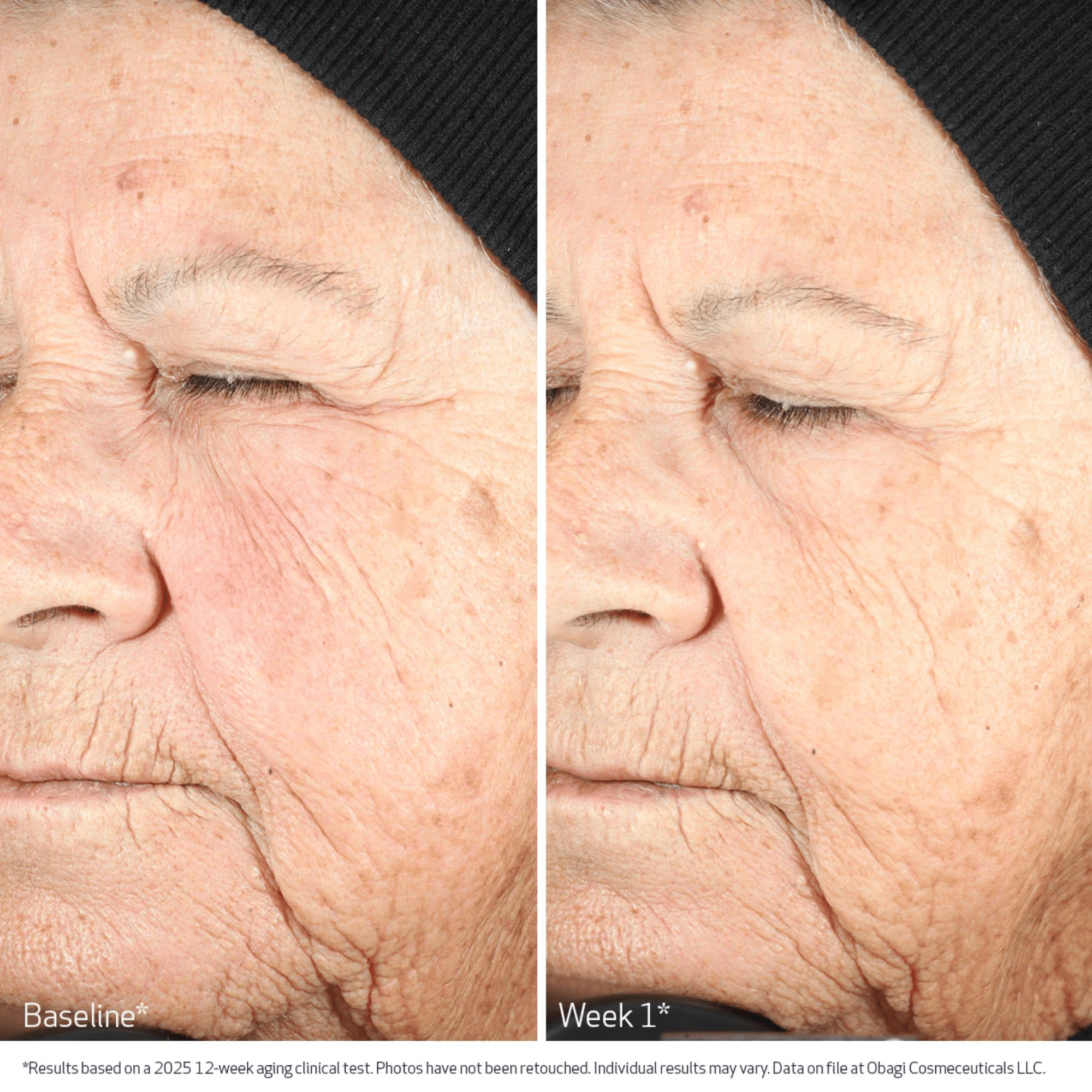 Obagi Nu-Gen Cellular Renewal Serum before and after results showing reduced wrinkles at baseline vs. Week 1. Available at Exclusive Beauty Club.