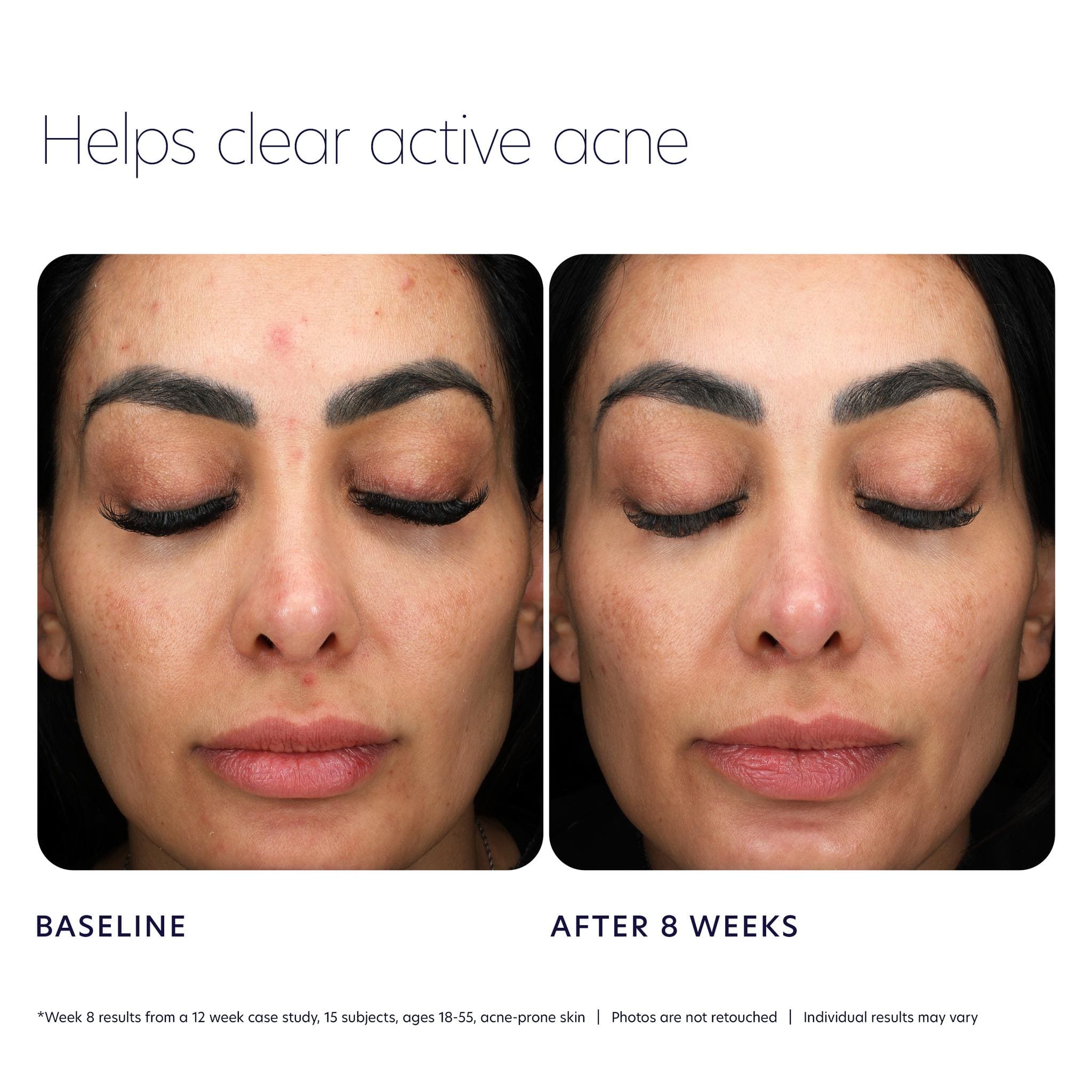 Before and after comparison showing clearer skin after eight weeks of acne control cleanser use
