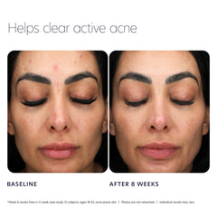 Before and after comparison showing clearer skin after eight weeks of acne control cleanser use