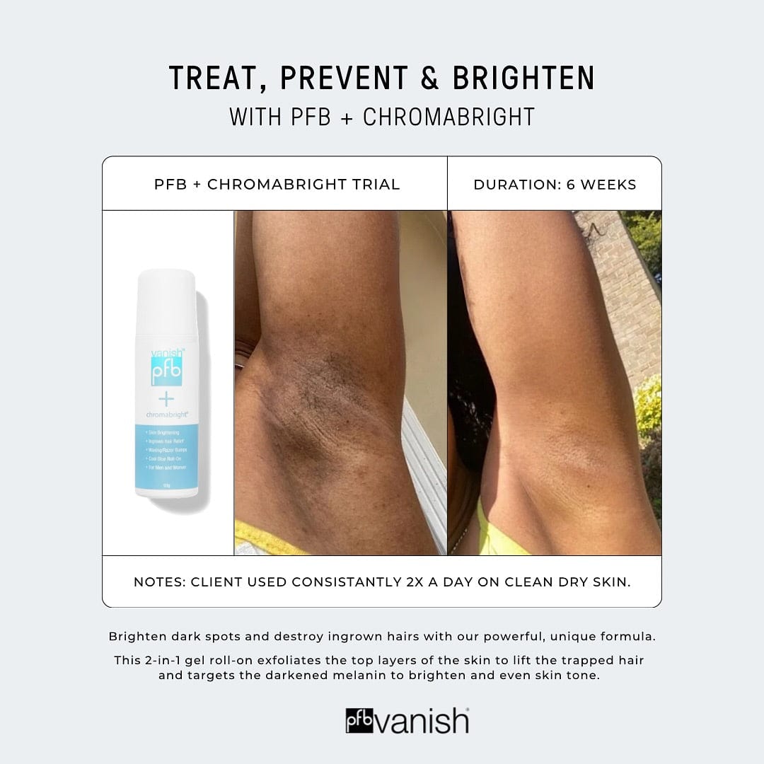 Advertisement for PFB + Chromabright skin treatment showing before and after results on legs.