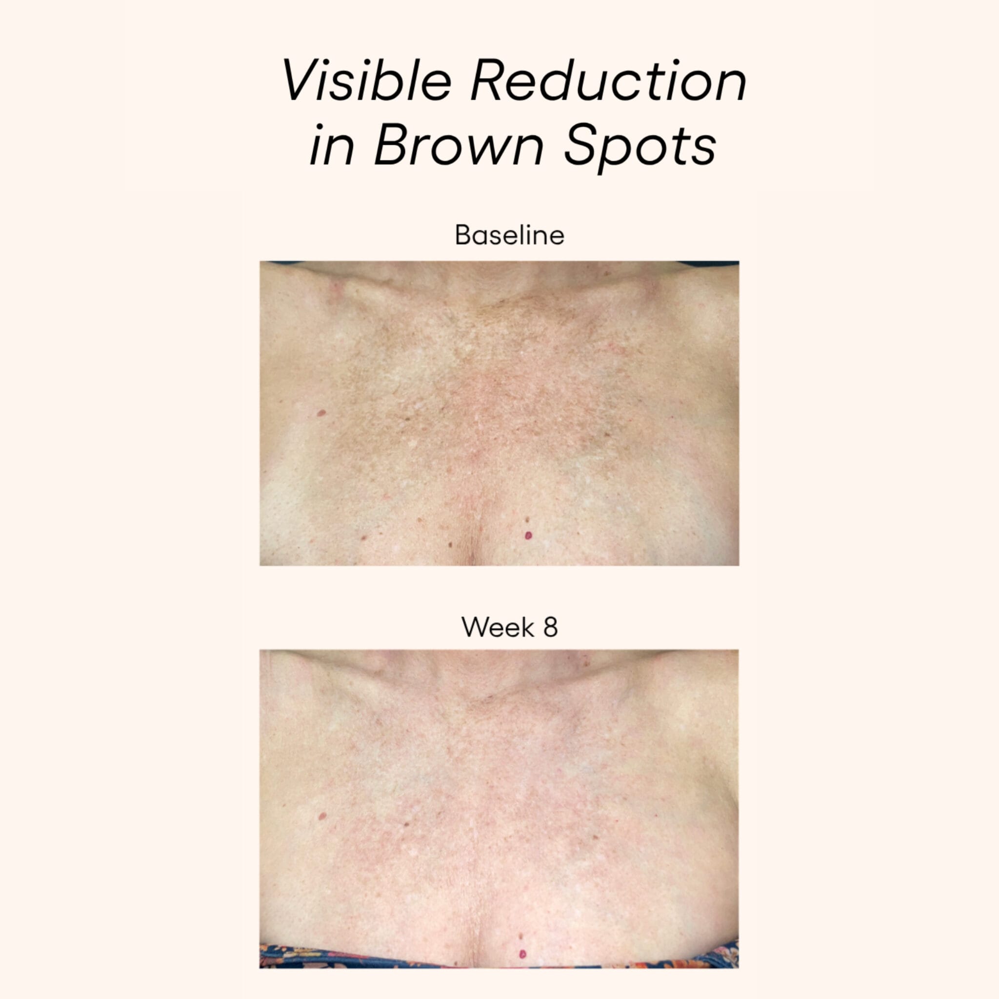 Plated Body Serum before and after results showing visible brown spot reduction on chest skin