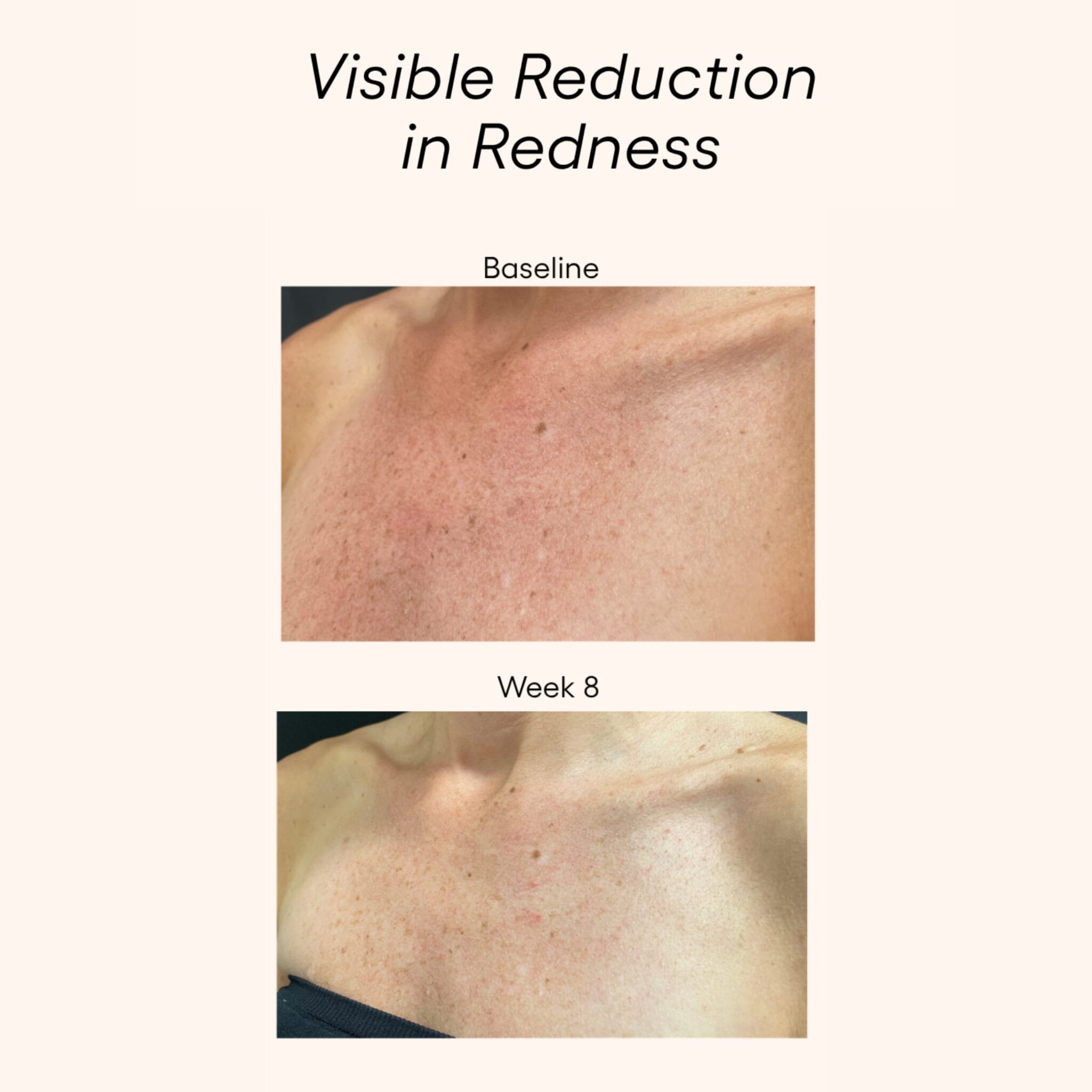 Plated Body Serum before and after results showing visible redness reduction on chest skin