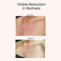 Plated Body Serum before and after results showing visible redness reduction on chest skin