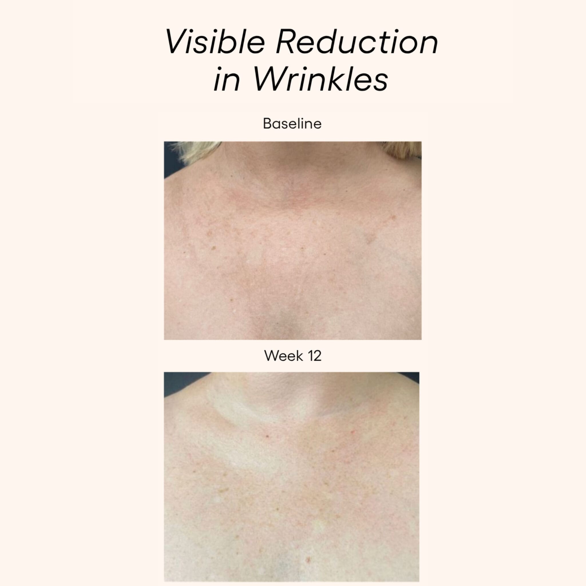 Plated Body Serum before and after results showing more even skin tone on chest skin