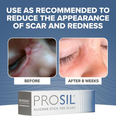 PROSIL Silicone Stick for Scars Before & After shop at Exclusive Beauty