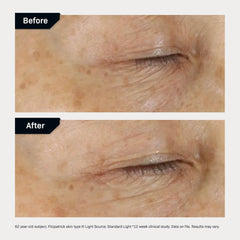 Before and after comparison of skin texture on a 62-year-old subject with Fitzpatrick skin type III.