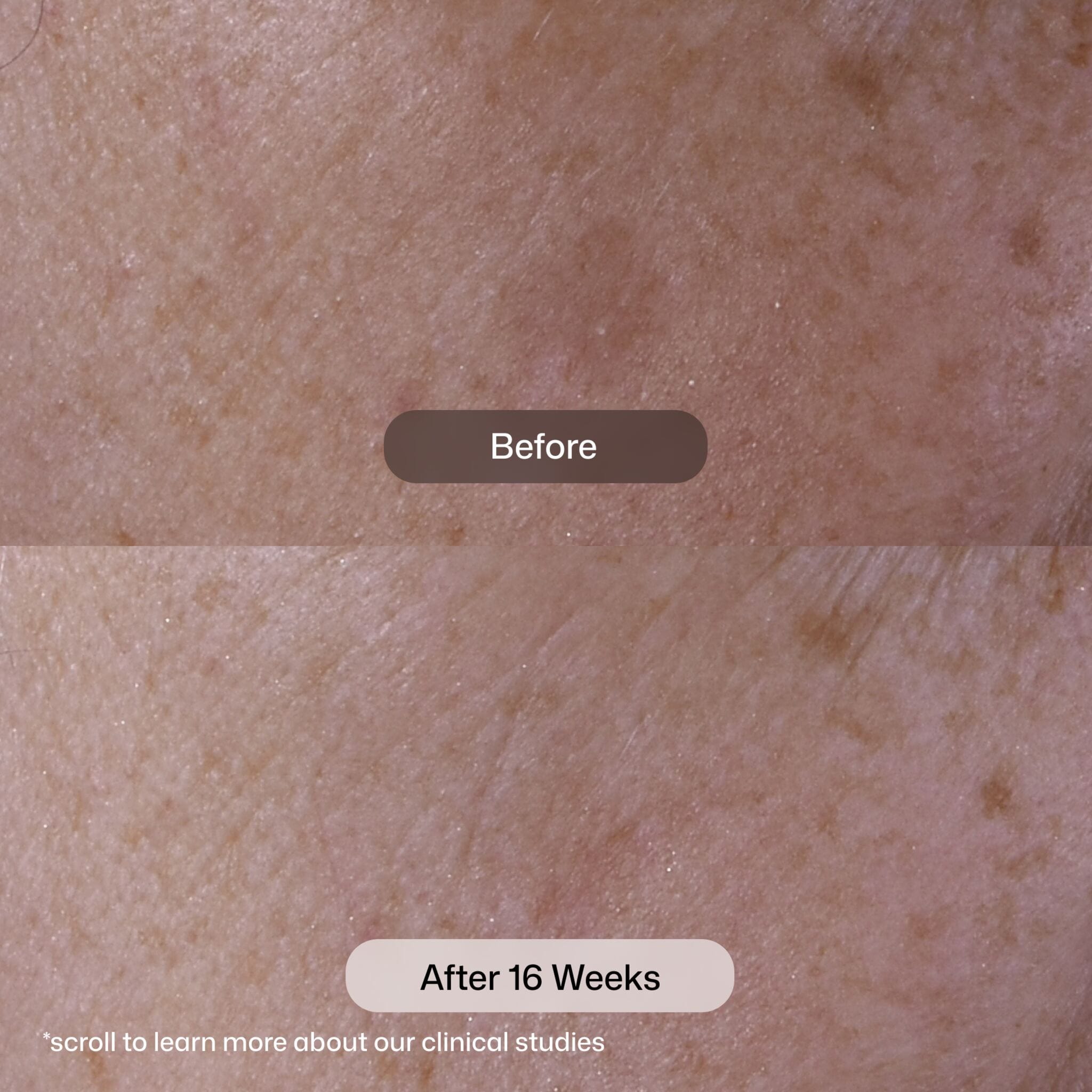 Before and after 16 weeks using Revision Skincare Advanced Pigment Corrector