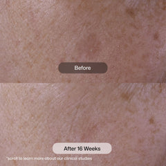 Before and after 16 weeks using Revision Skincare Advanced Pigment Corrector