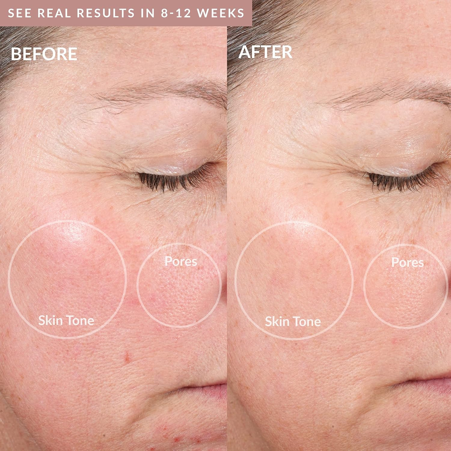 PMD Microderm Elite Pro Rose 3