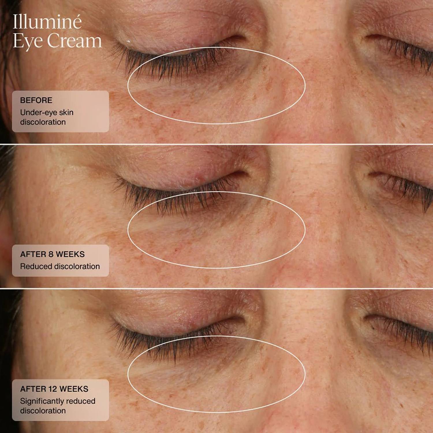 Senté Illuminé Eye Cream before and after 8 and 12 weeks showing significantly reduced under-eye discoloration