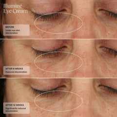Senté Illuminé Eye Cream before and after 8 and 12 weeks showing significantly reduced under-eye discoloration