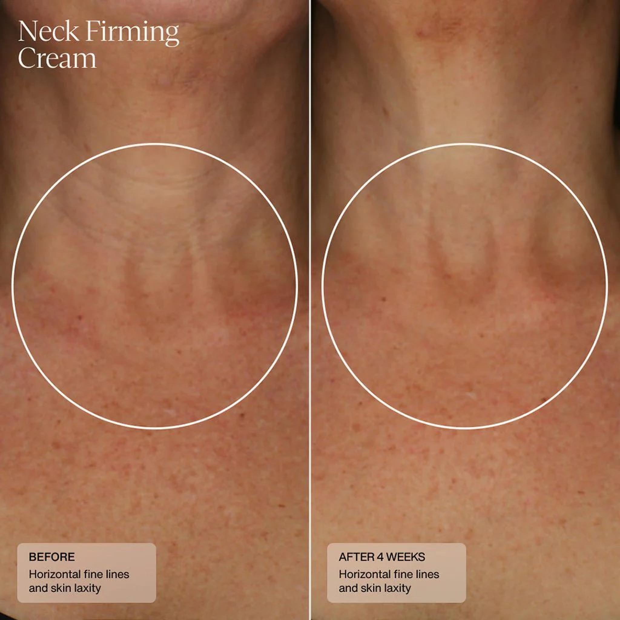 Senté Neck Firming Cream before and after 4 weeks showing visibly reduced horizontal fine lines and improved skin laxity on the neck