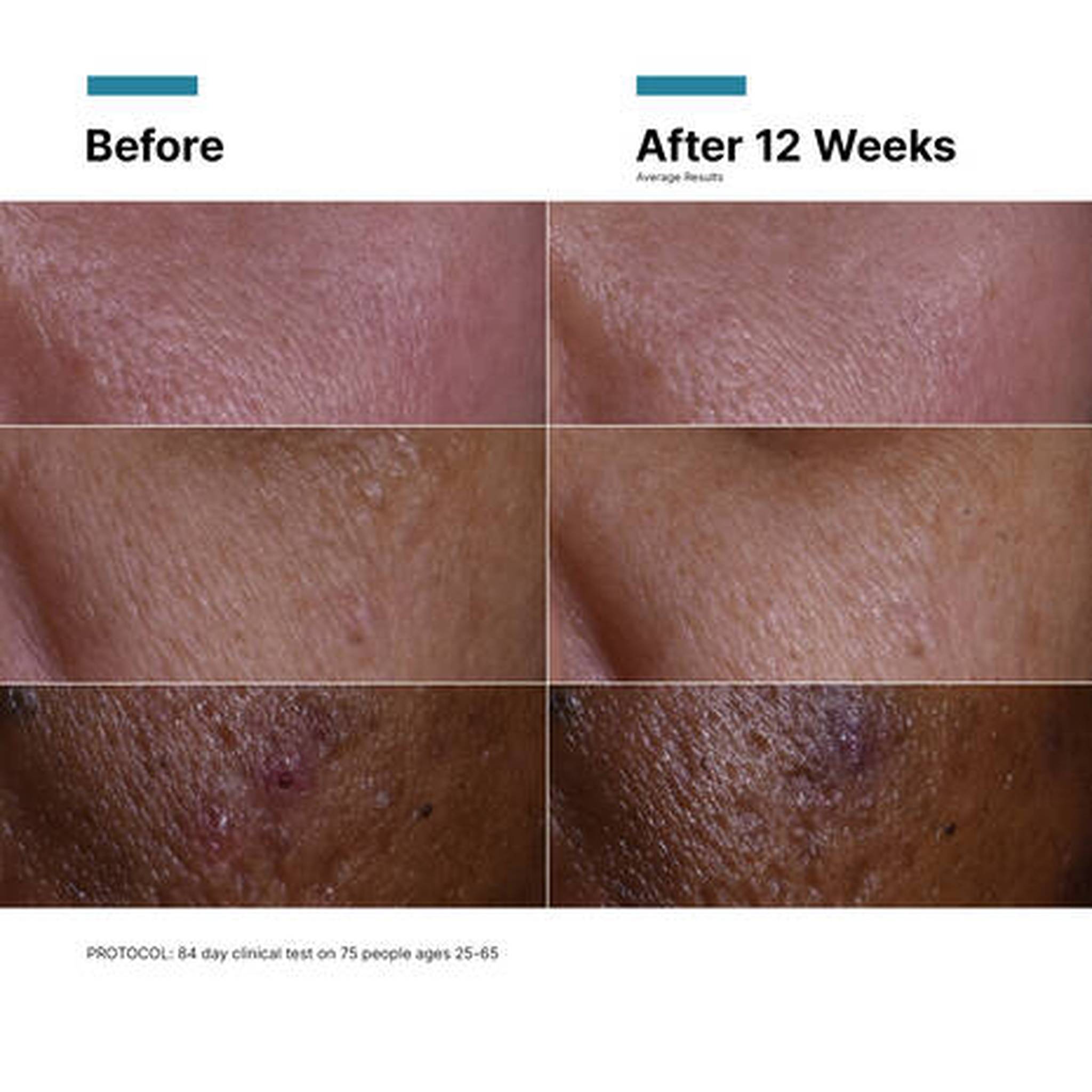 Skin before and after twelve weeks of vitamin C serum use