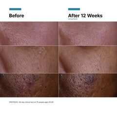Skin before and after twelve weeks of vitamin C serum use