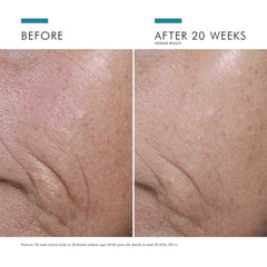 Skin before and after 20 weeks of CE Ferulic serum use