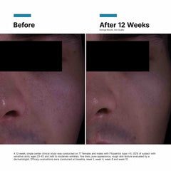SkinCeuticals P-TIOX before and after 12 weeks showing improved skin quality and reduced wrinkle and pore appearance