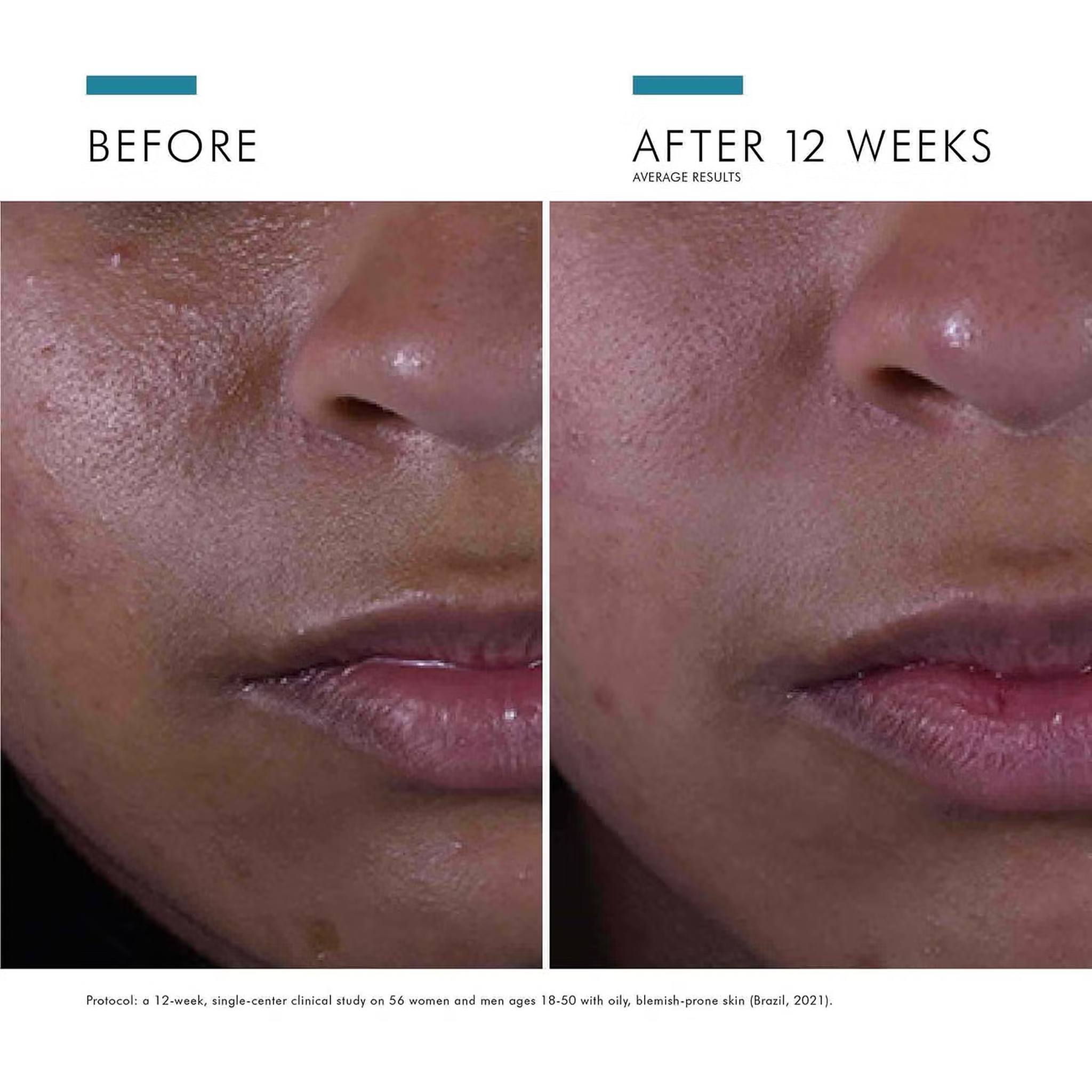 SkinCeuticals Silymarin CF before and after 12 weeks showing fewer blemishes and clearer oily skin