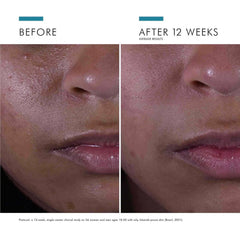 SkinCeuticals Silymarin CF before and after 12 weeks showing fewer blemishes and clearer oily skin