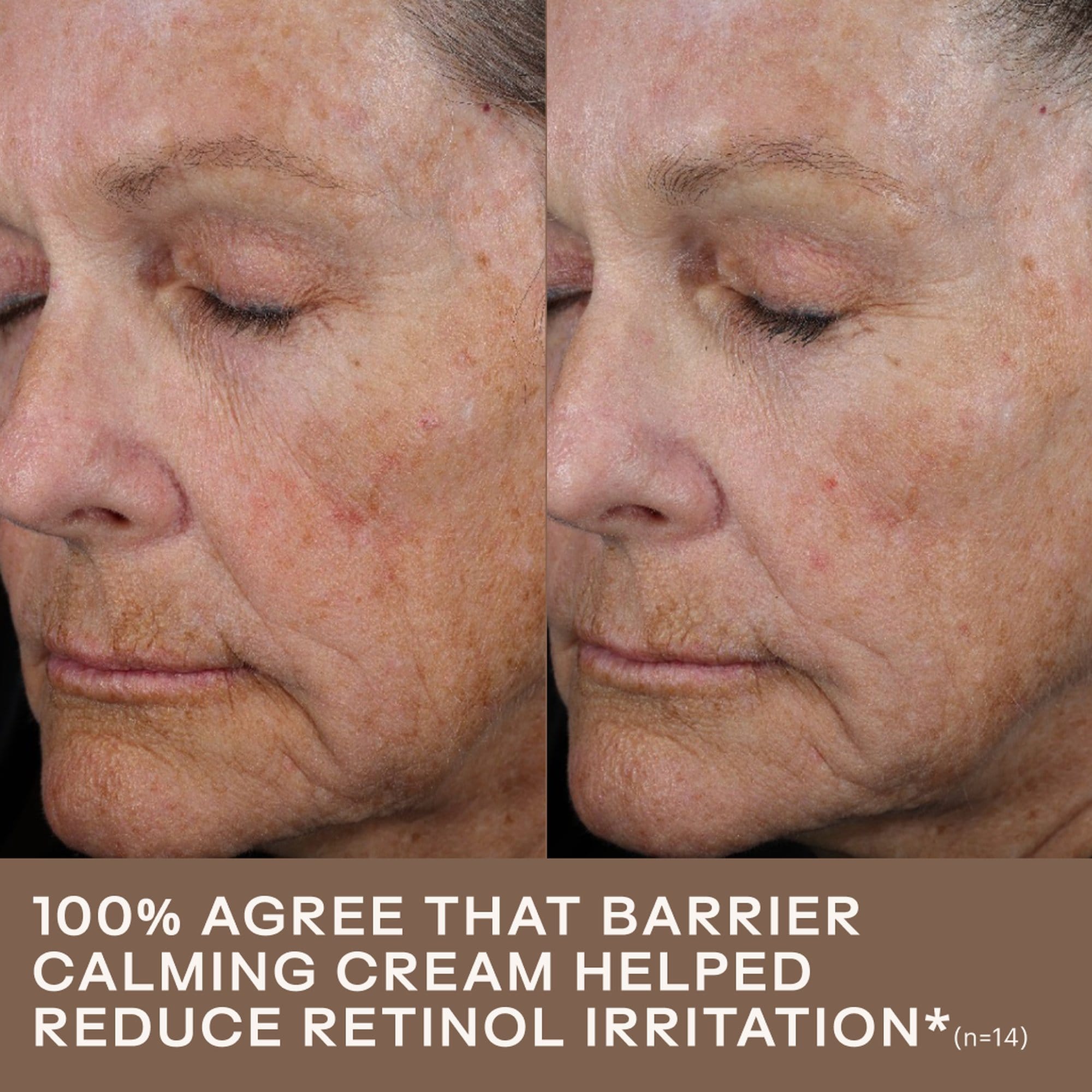 Before and after six weeks showing reduced retinol related irritation