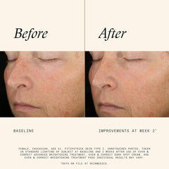 Before and after clinical results showing skin improvements at week 2 using SkinMedica Even & Correct Brightening Treatment Pads