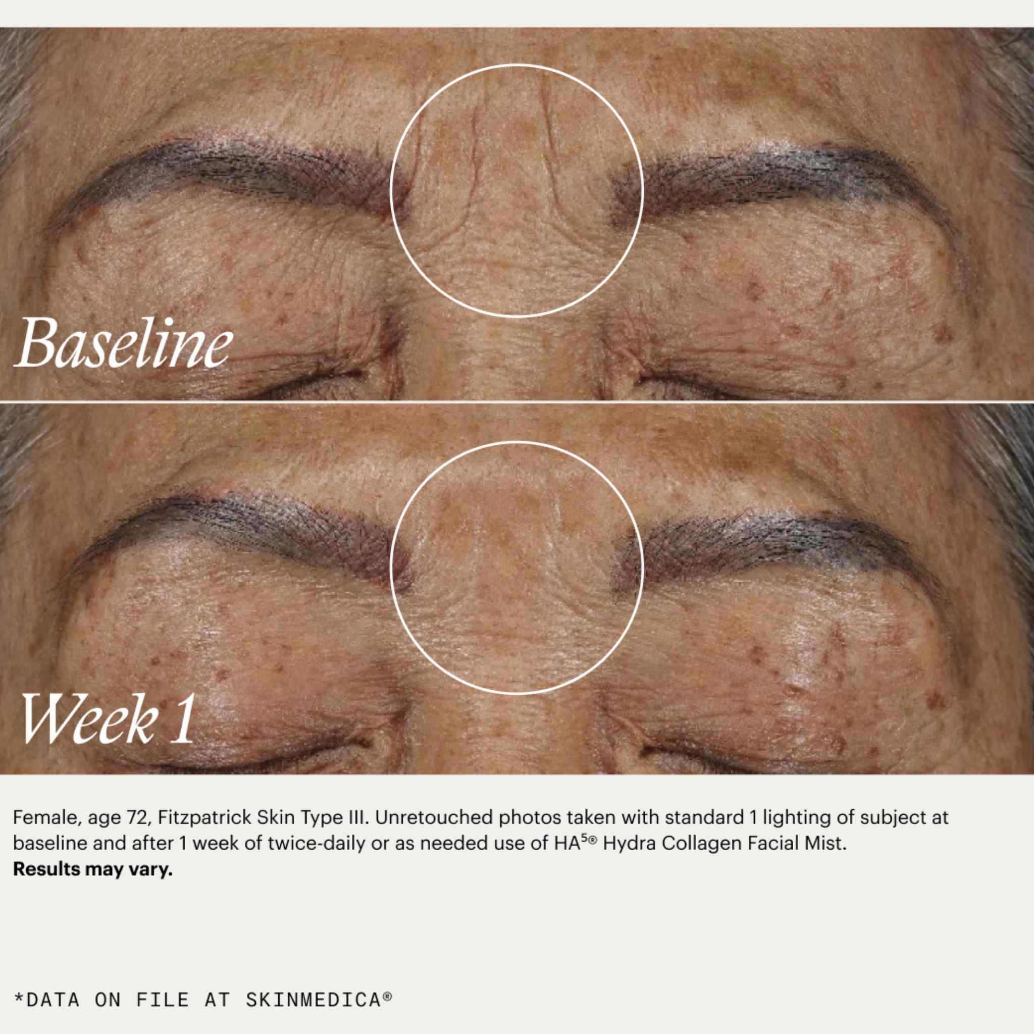 SkinMedica HA5 Hydra Collagen Facial Mist before and after 1 week showing visibly reduced forehead wrinkles and smoother skin
