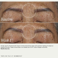 SkinMedica HA5 Hydra Collagen Facial Mist before and after 1 week showing visibly reduced forehead wrinkles and smoother skin