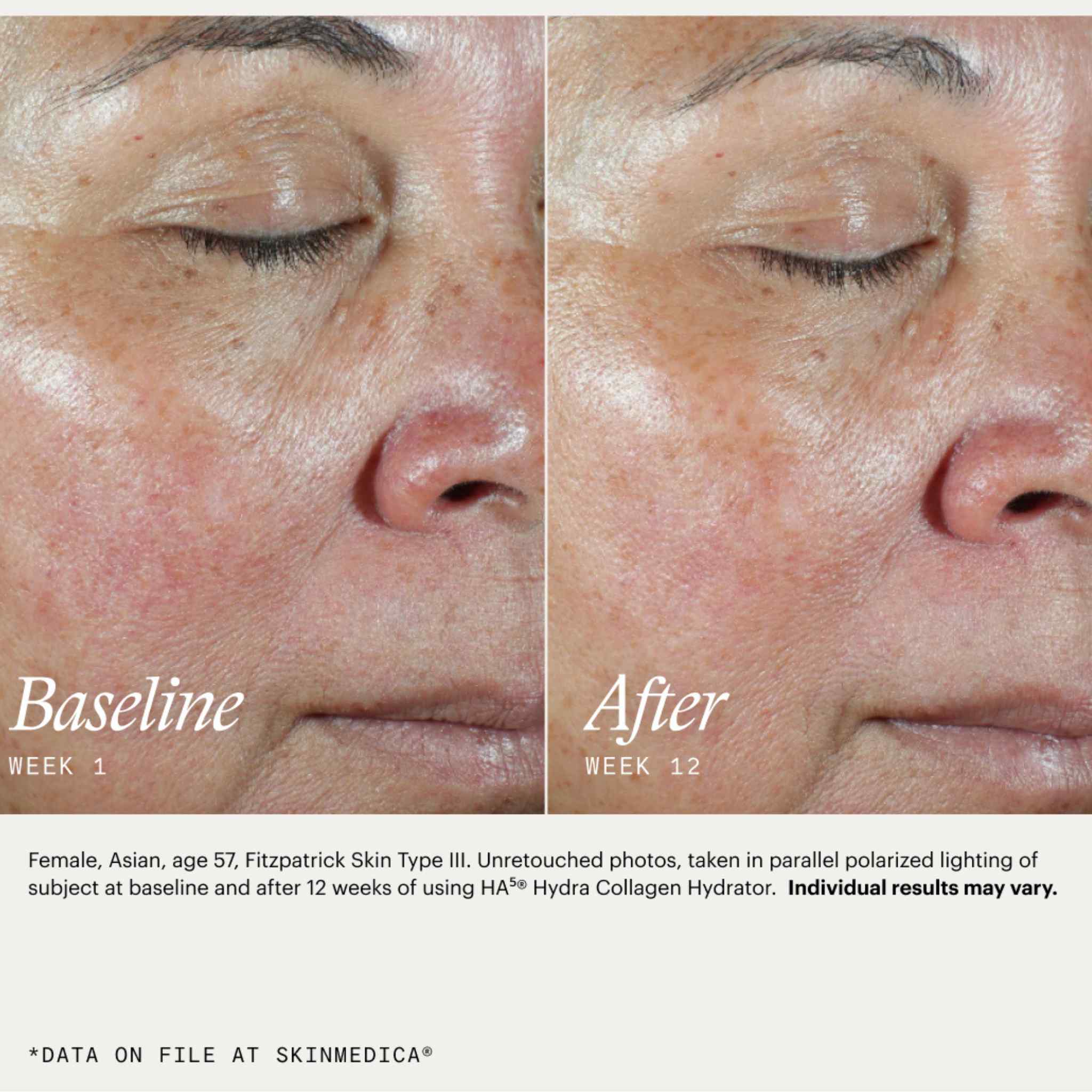 SkinMedica HA5 Hydra Collagen Hydrator before and after 12 weeks showing visibly smoother skin and reduced redness
