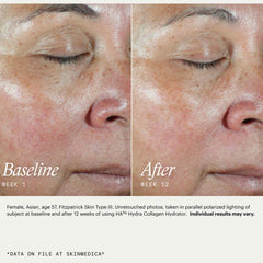 SkinMedica HA5 Hydra Collagen Hydrator before and after 12 weeks showing visibly smoother skin and reduced redness