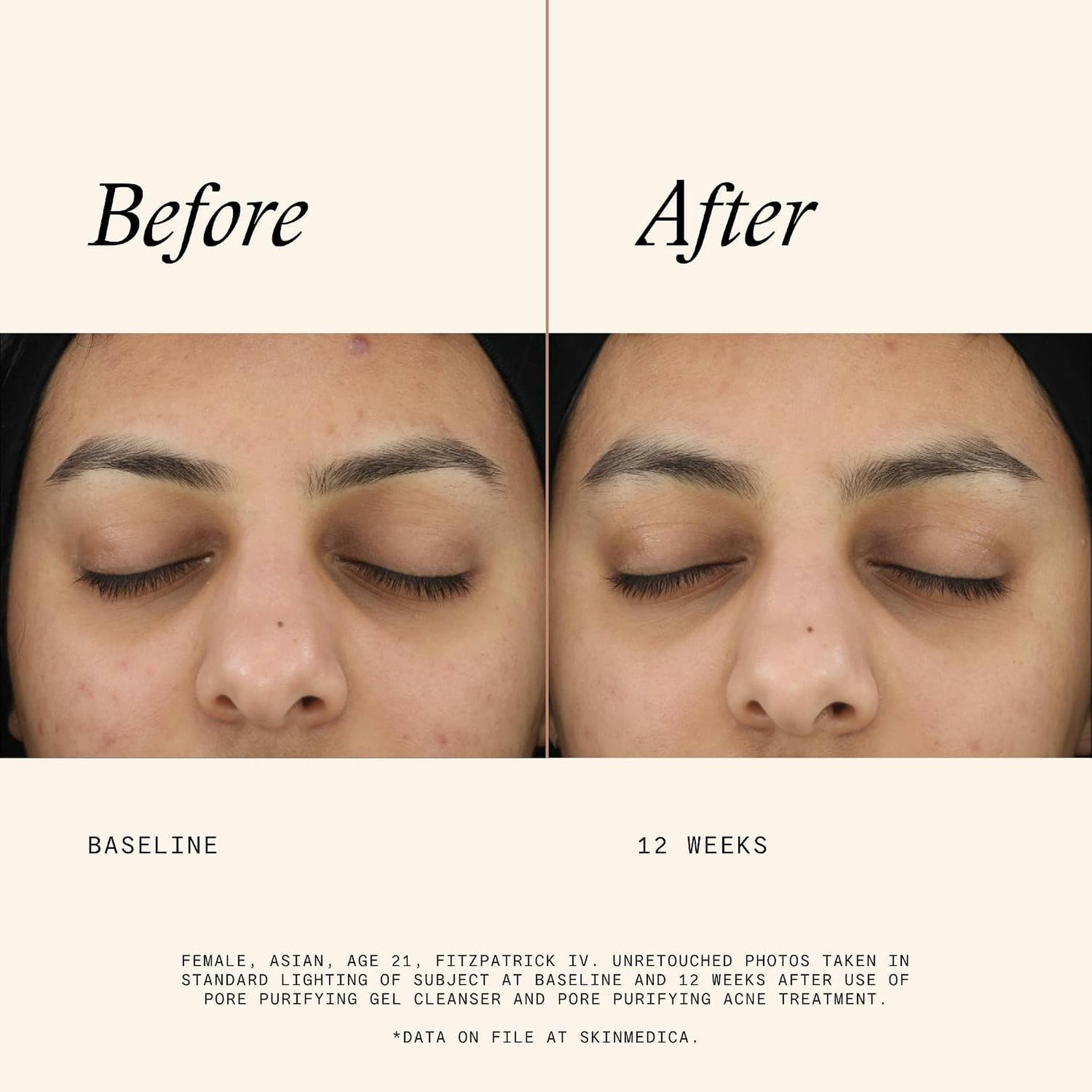 Before and after 12 weeks using SkinMedica Pore Purifying Gel Cleanser showing clearer skin and reduced acne marks
