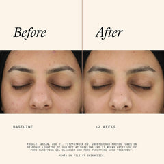 Before and after 12 weeks using SkinMedica Pore Purifying Gel Cleanser showing clearer skin and reduced acne marks