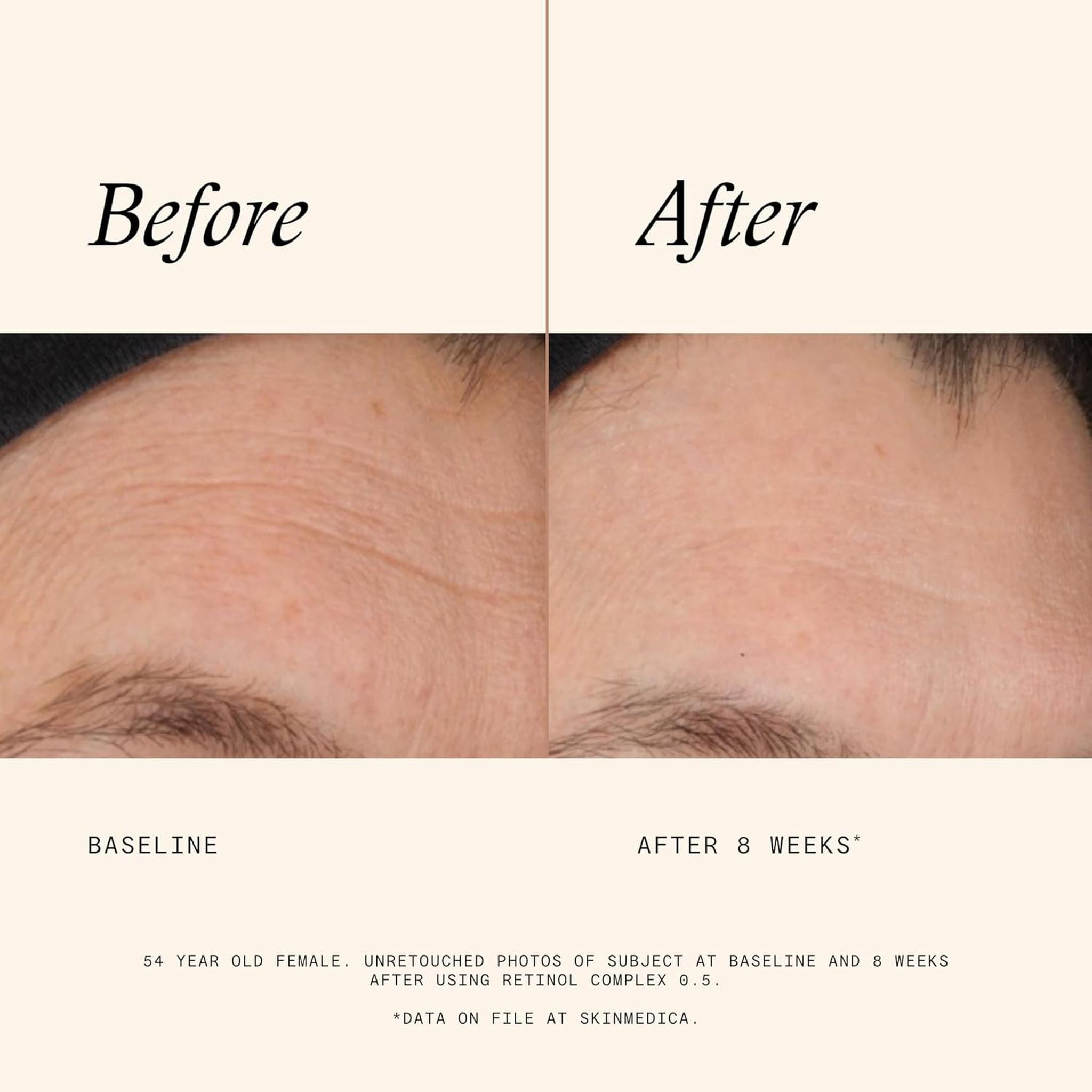 SkinMedica Retinol Complex 0.5 before and after 8 weeks – visible reduction in fine lines and wrinkles