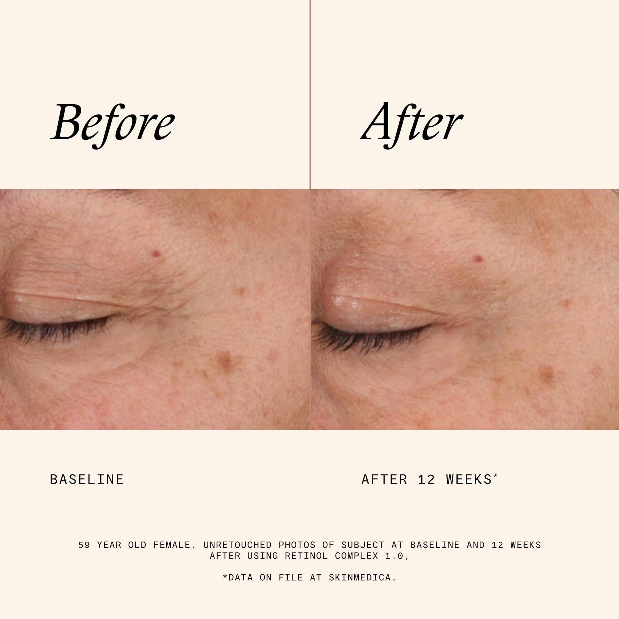 Before and after 12 weeks using SkinMedica Retinol Complex 1.0 showing reduced fine lines and wrinkles