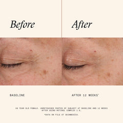 Before and after 12 weeks using SkinMedica Retinol Complex 1.0 showing reduced fine lines and wrinkles