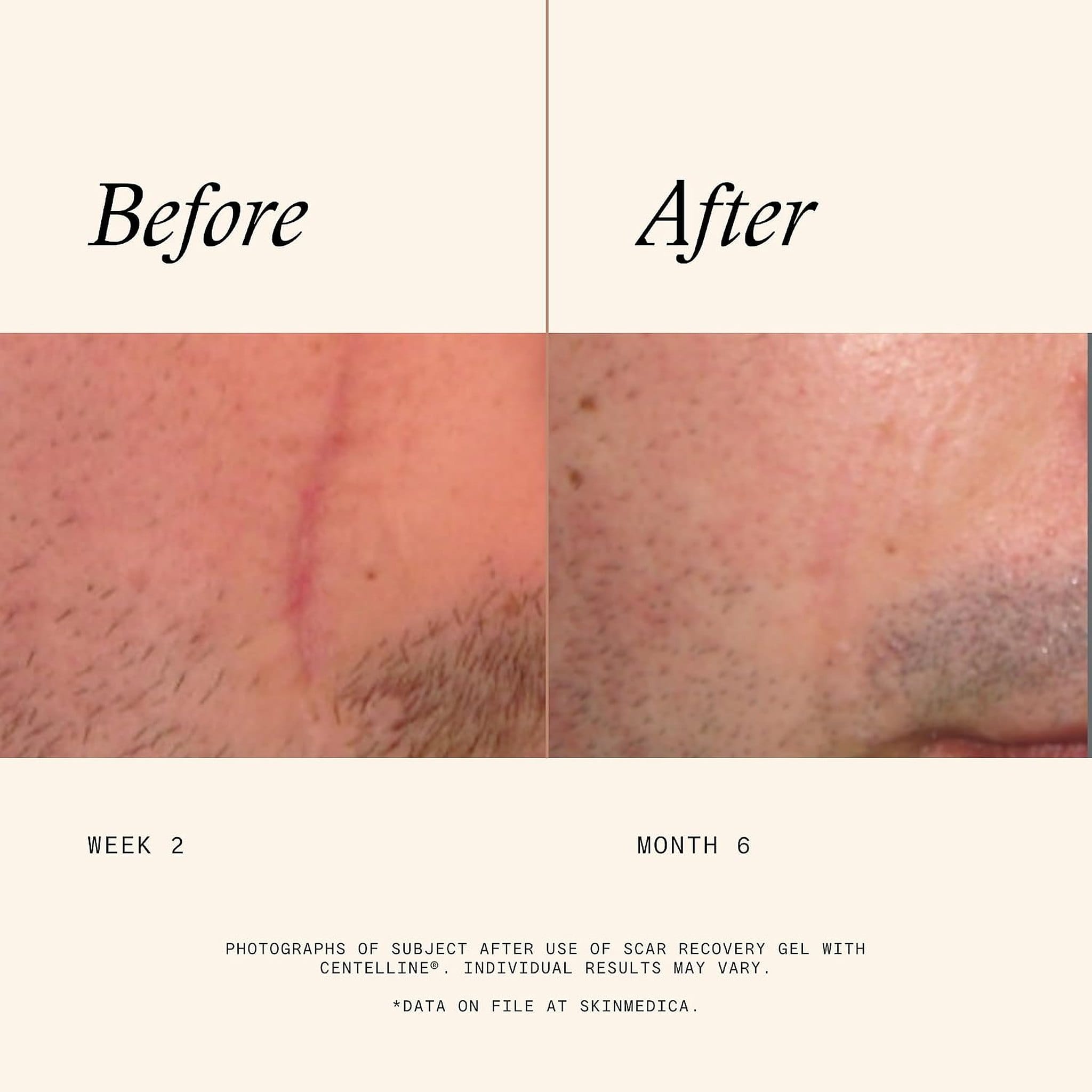 SkinMedica Scar Recovery Gel before and after results showing a faded facial scar from week 2 to month 6