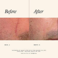 SkinMedica Scar Recovery Gel before and after results showing a faded facial scar from week 2 to month 6