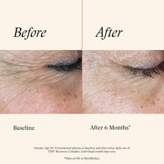 Before and after comparison of skin texture on a person's eyelid with text indicating time elapsed and product use.